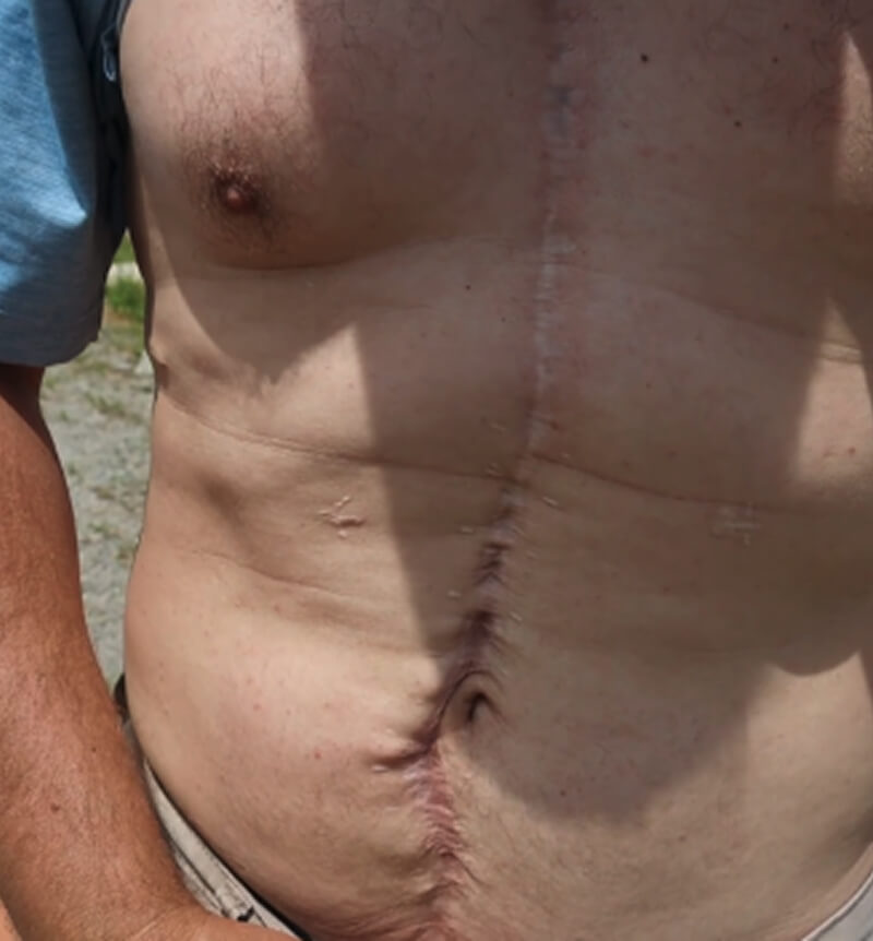 Jason's stomach with stitch